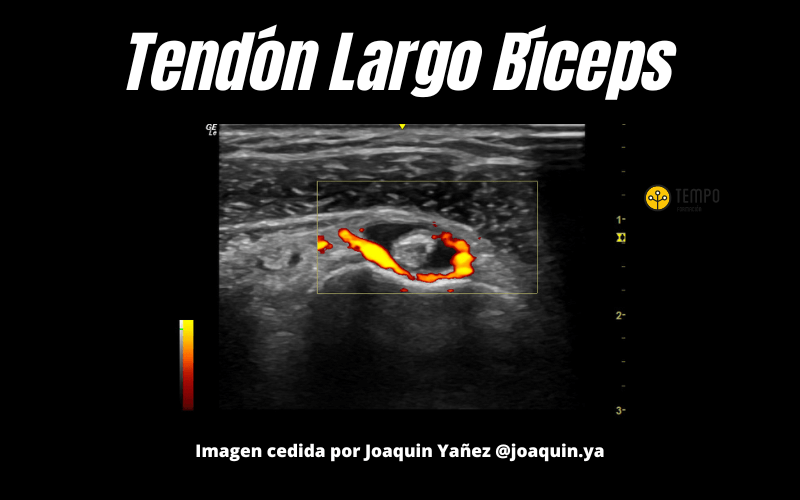 6. Tendon Largo Biceps Ecografia Tempo Formacion.png